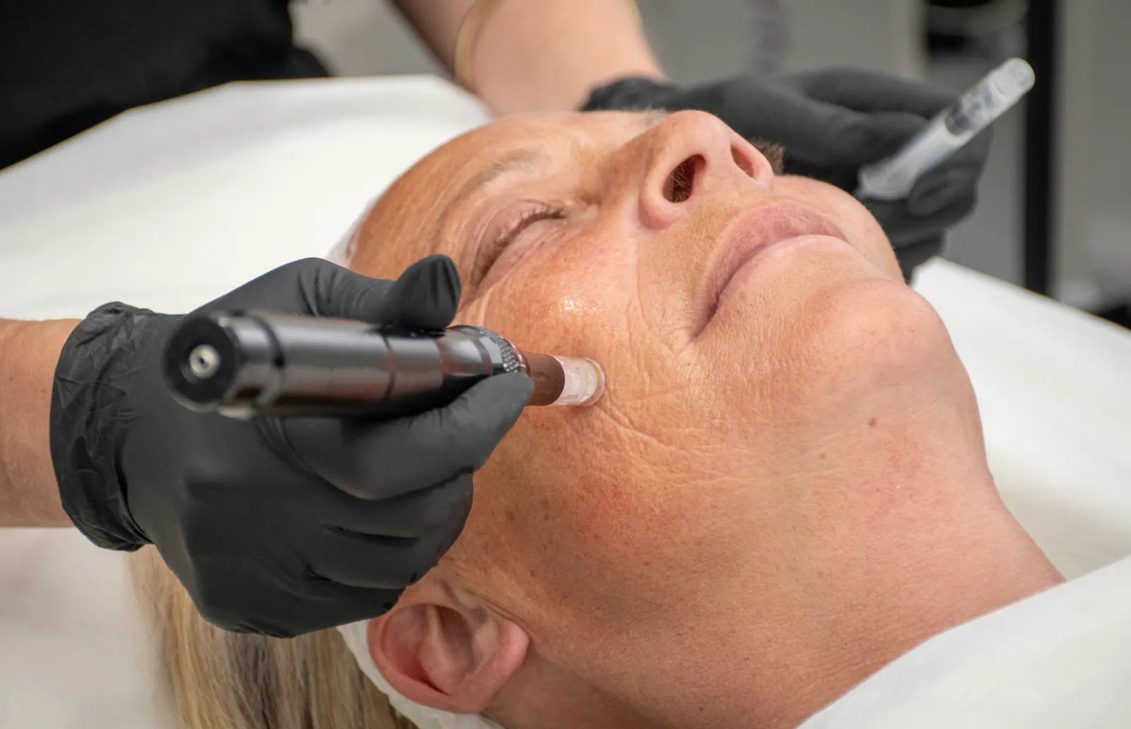 A skin treatment device being used on a client's face at KM Skin and Laser Clinic.