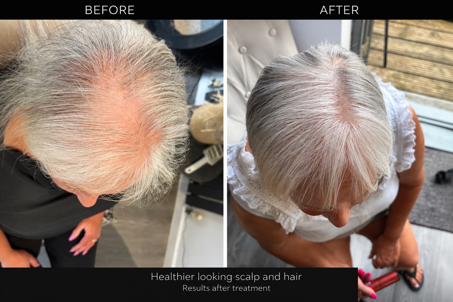 Before and after scalp and hair results following treatment.