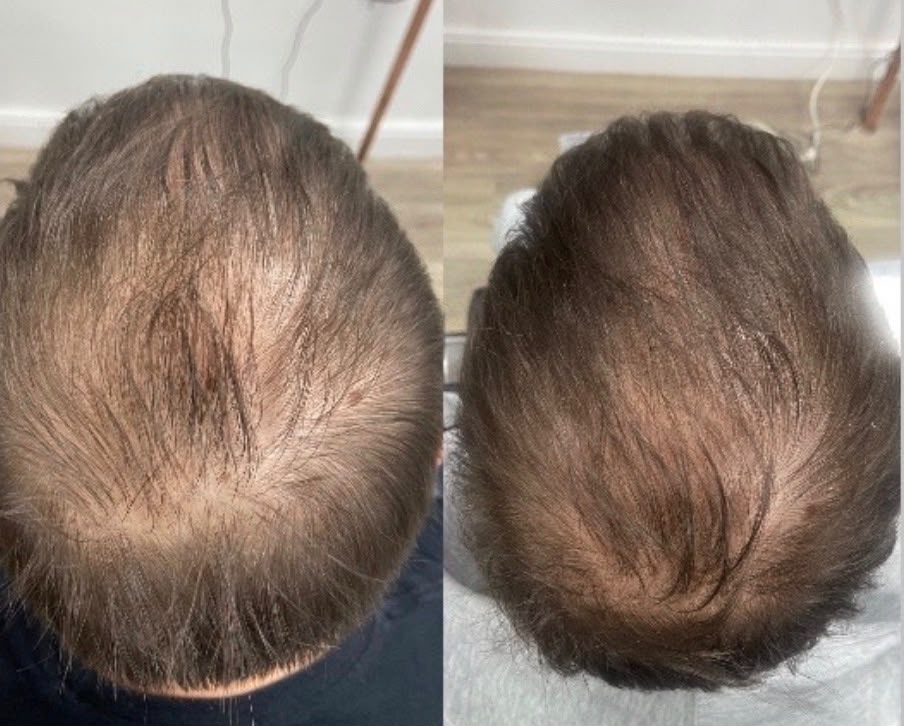 Before and after hair-density results following treatment.
