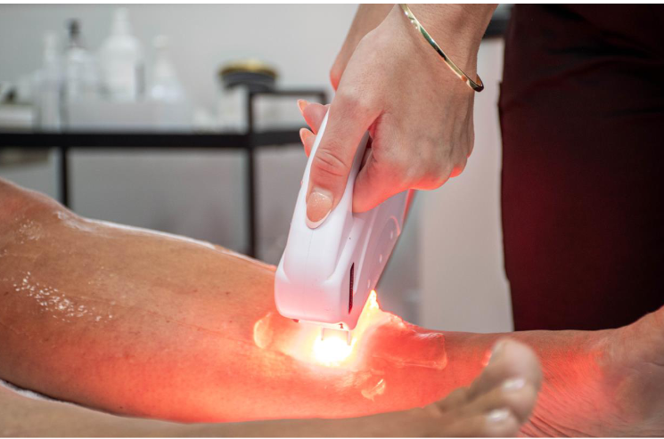 An IPL hair-removal treatment being carried out on a client's lower leg.