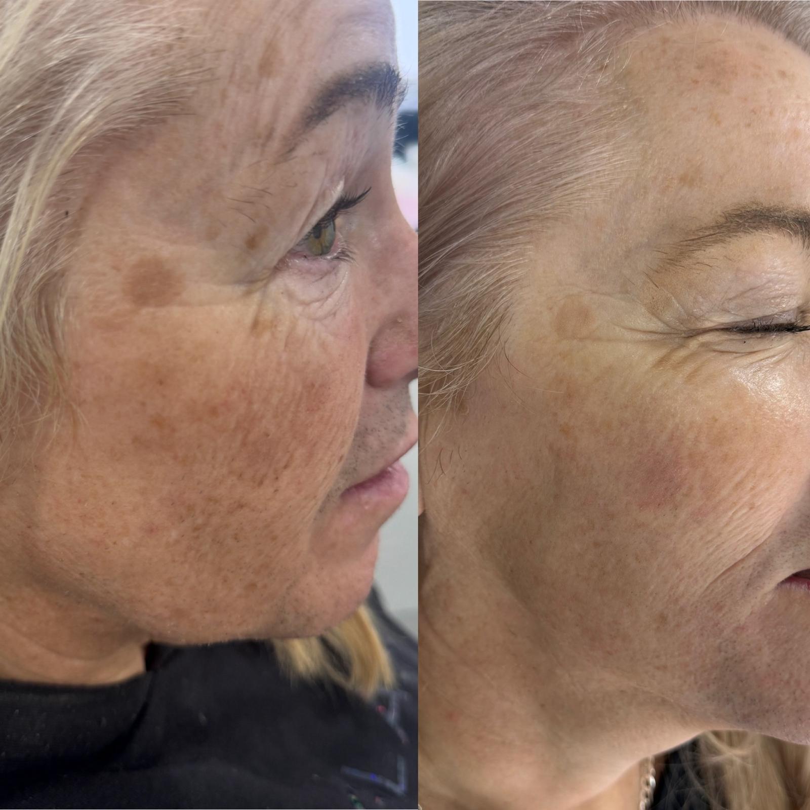 Client skin before and after IPL skin rejuvenation treatment.