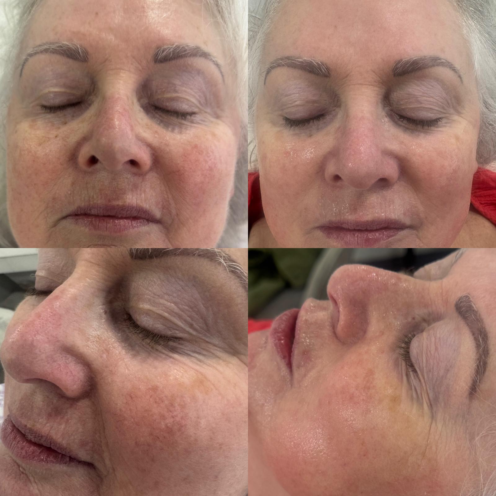Close-up client skin results following IPL skin rejuvenation treatment.