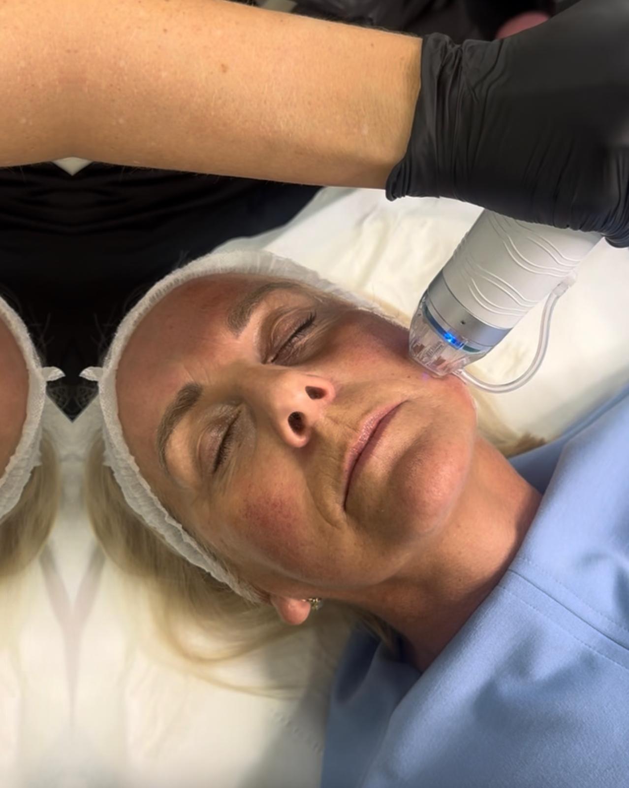 A microneedling treatment being carried out in the clinic.