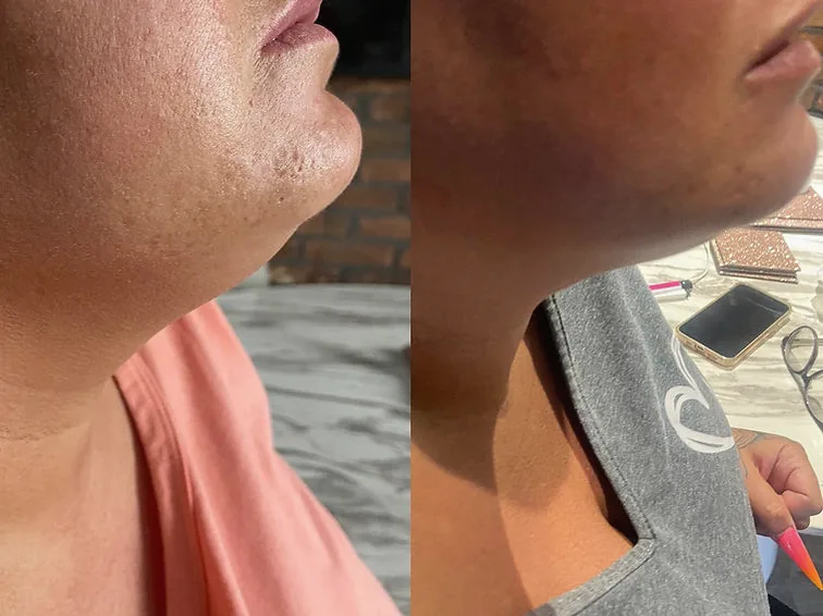 Before and after side-profile result after fat dissolving treatment.