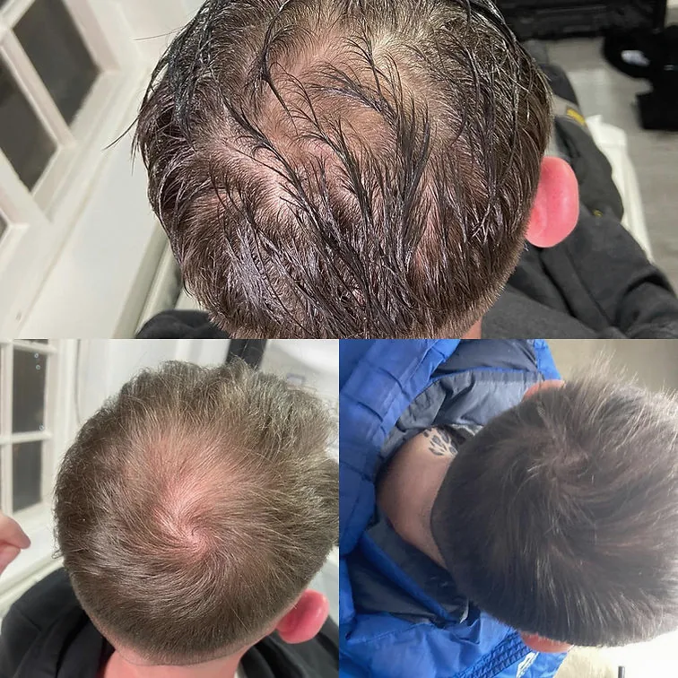 Before and after crown hair growth treatment photos.