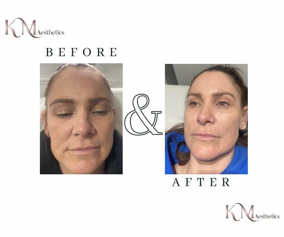 Before and after microneedling facial result.