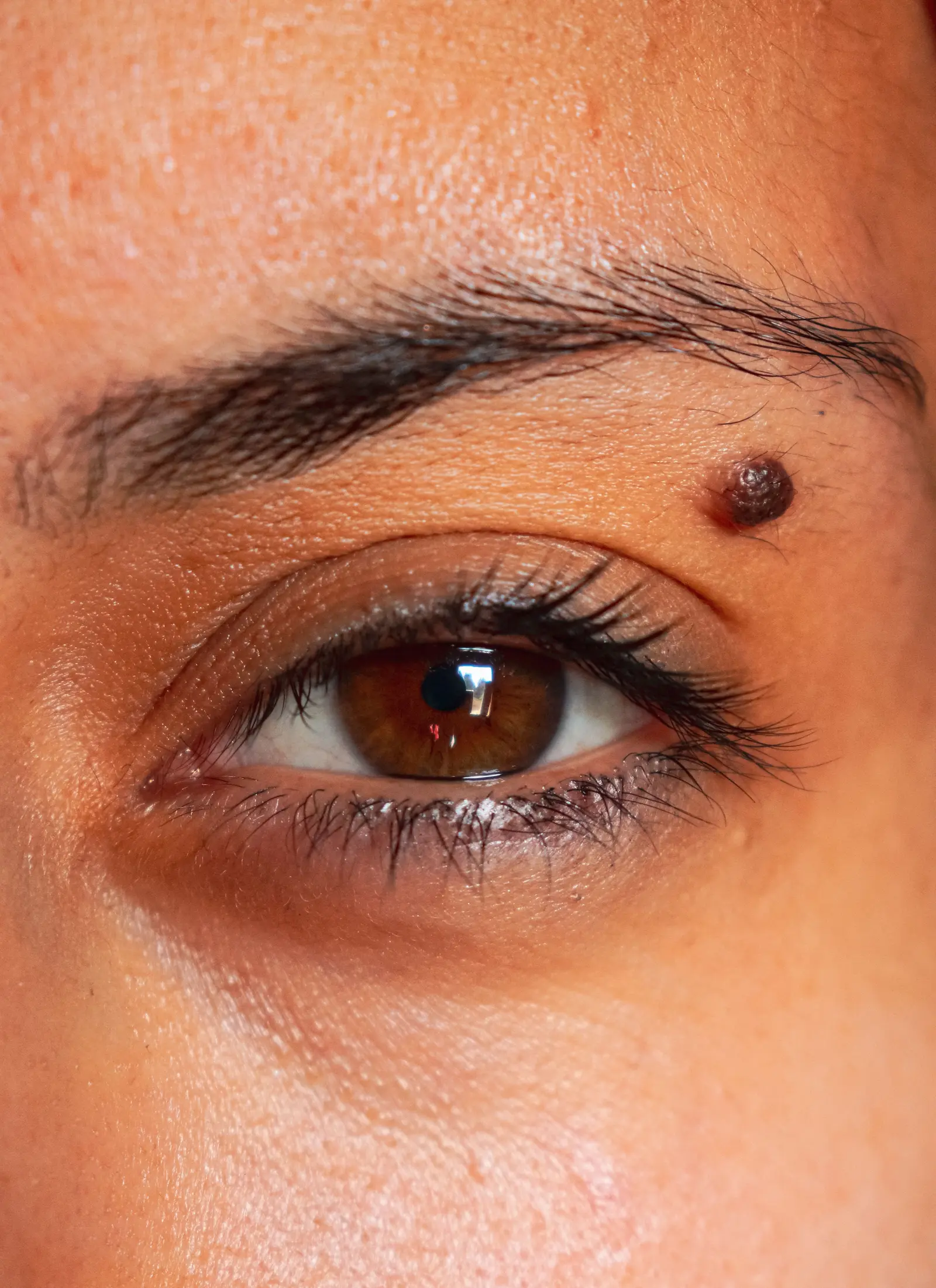 Close-up of a raised skin growth beside the eye.