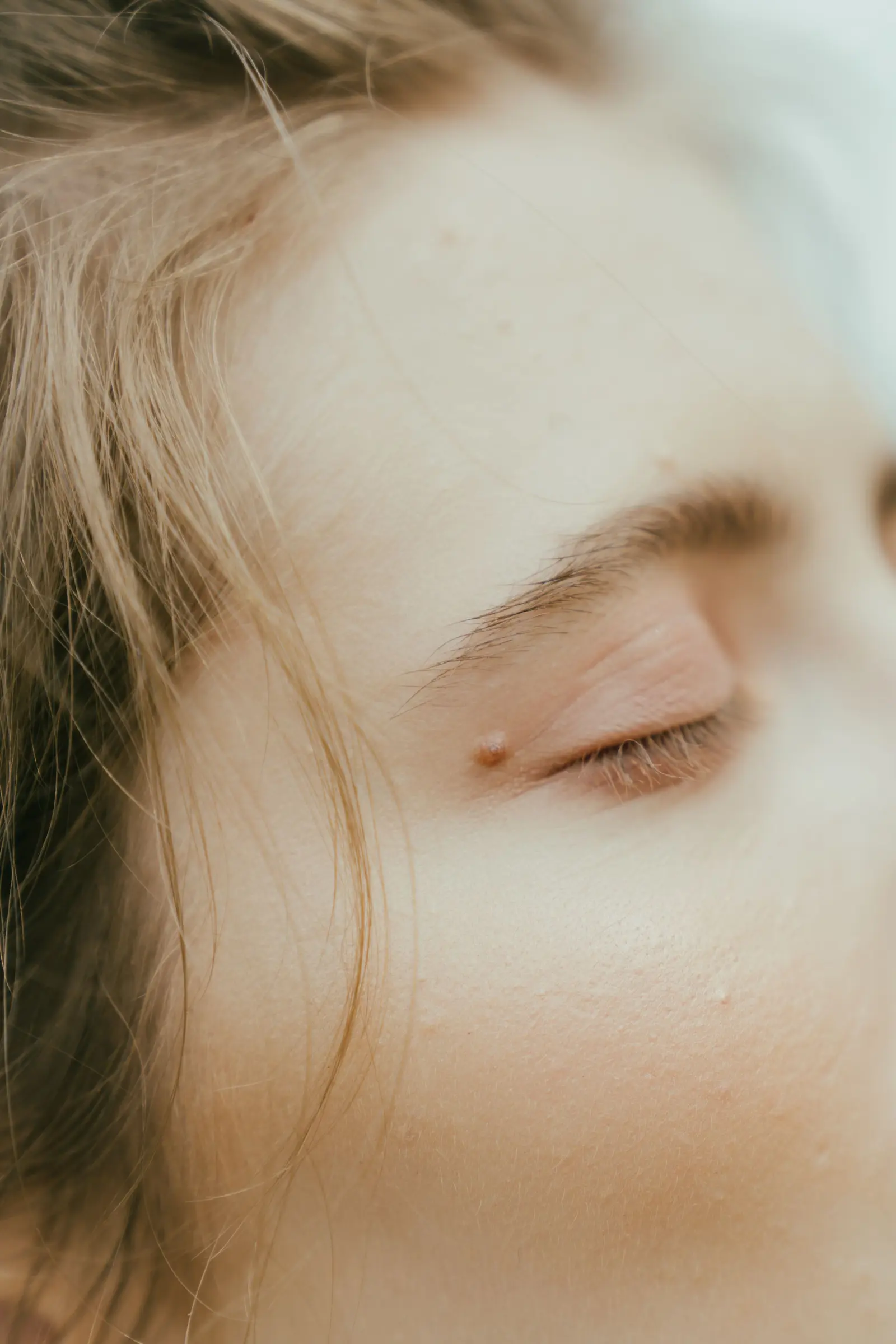 Close-up of a small skin tag near the eyelid.